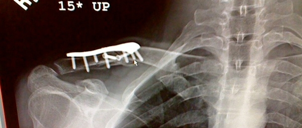 Bens Crash X-ray